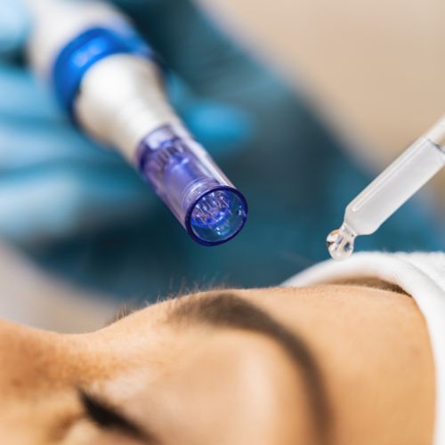 Microagujas con Facial Limpieza Profunda