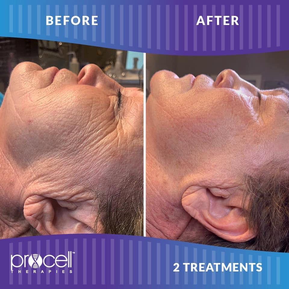 Procell nuevo tratamiento