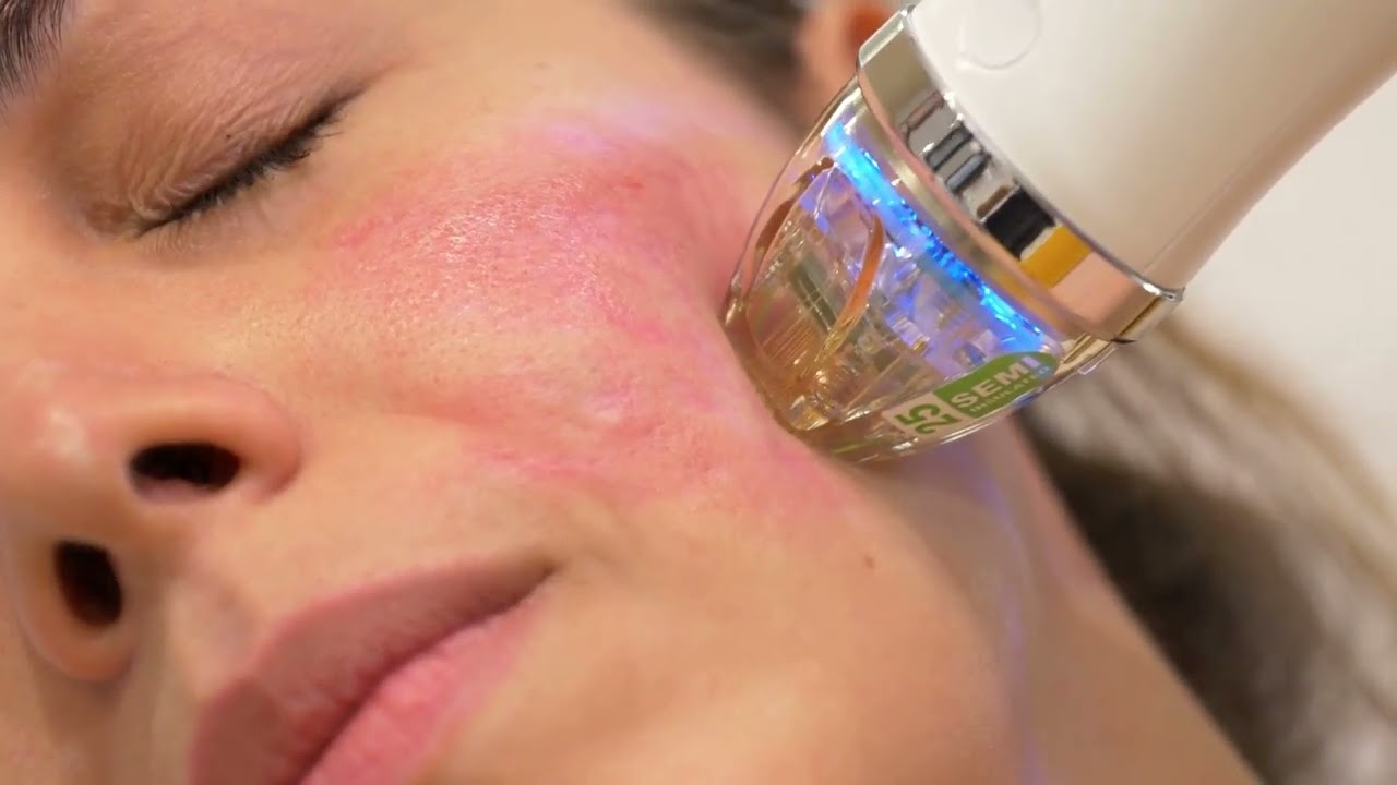 Limpieza profunda,Radiofrecuencia Fraccionada